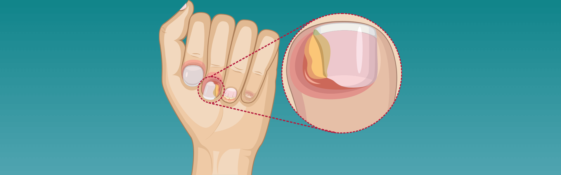 Paronychia Nail Infection | Paronychia Treatment India - Manipal
